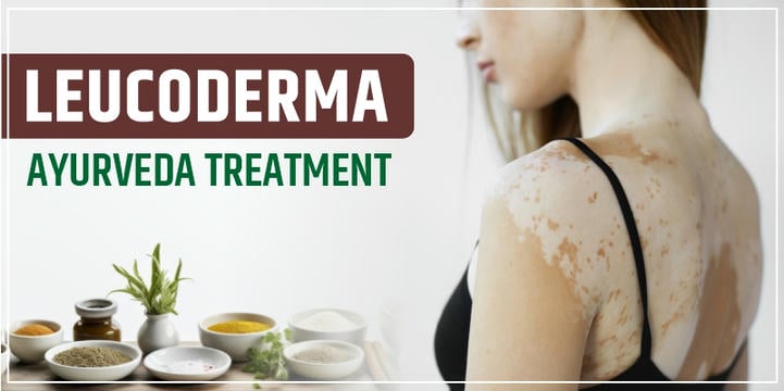leucoderma-ayurveda-treatment